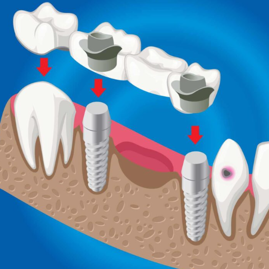 2025년 임플란트 의료보험적용대상 완벽 가이드