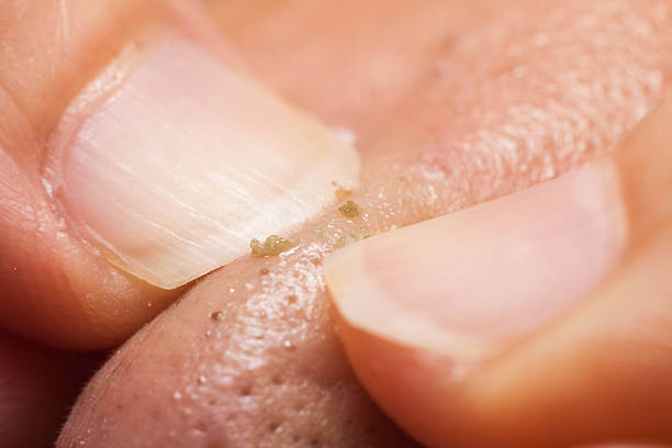 소극성 속모증은 블랙헤드와는 다른 증상이 있습니다. 간혹 콧등이나 콧볼에 작고 검은 점들이 조밀하게 형성되어 있는 것을 보고 보통 블랙헤드이지만&amp;#44; 모공 밖으로 나오는 검은 털인 속극성 속모증이 보이는 경우도 있습니다. 어떤 증상과 원인 치료방법이 있는지 참고하시기 바랍니다. 