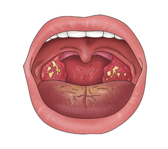 아데노이드 수술