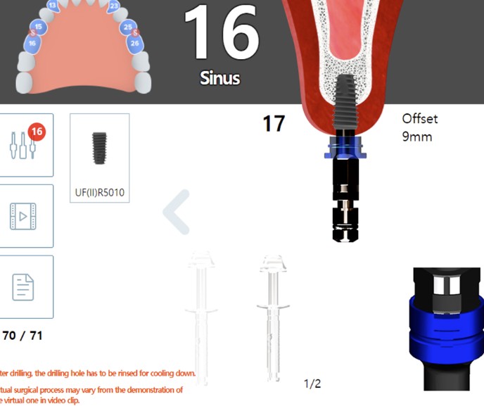 디오 임플란트 디오나비 3D 구강스캔&amp;#44; 3D 컴퓨터 모의시술