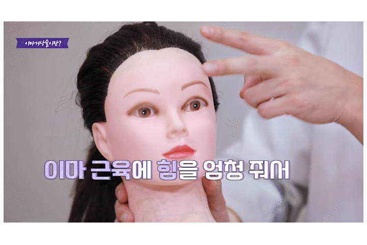 이마주름보톡스 송파성형외과