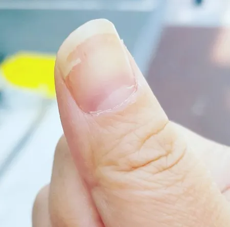 손톱이 갈라지는 이유 원인 증상 대처법_3