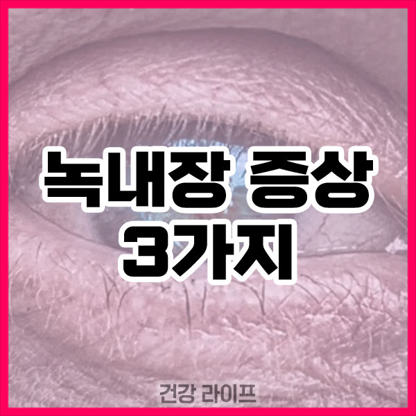 녹내장 증상
