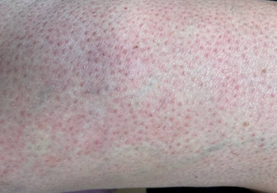 모공각화증 피부 증상