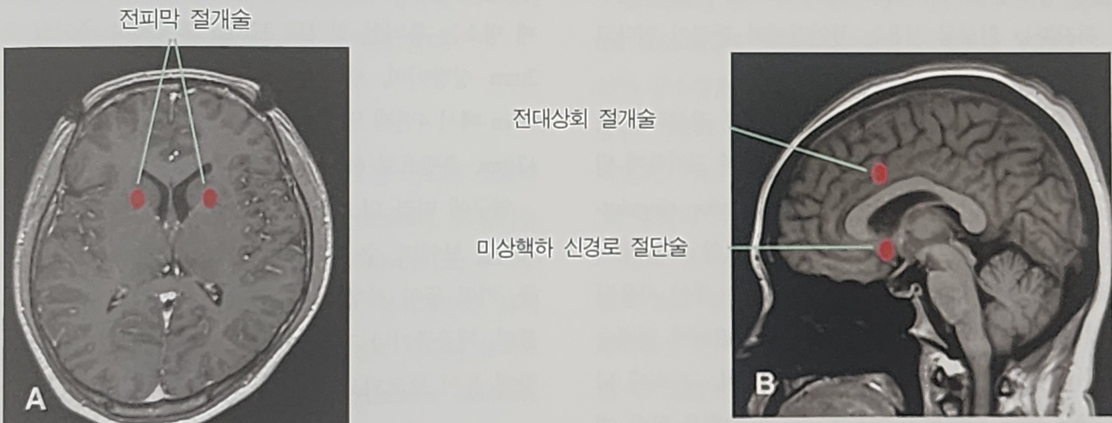 정신질환의 수술적 치료