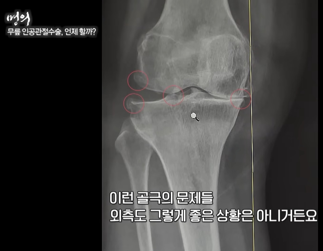 EBS명의-무릎-김성환-교수
