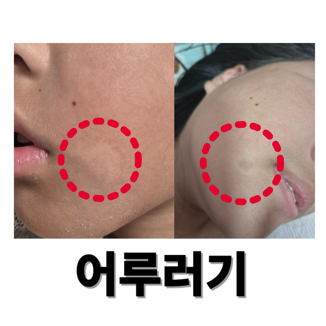 어루러기와 관련된 사진입니다.