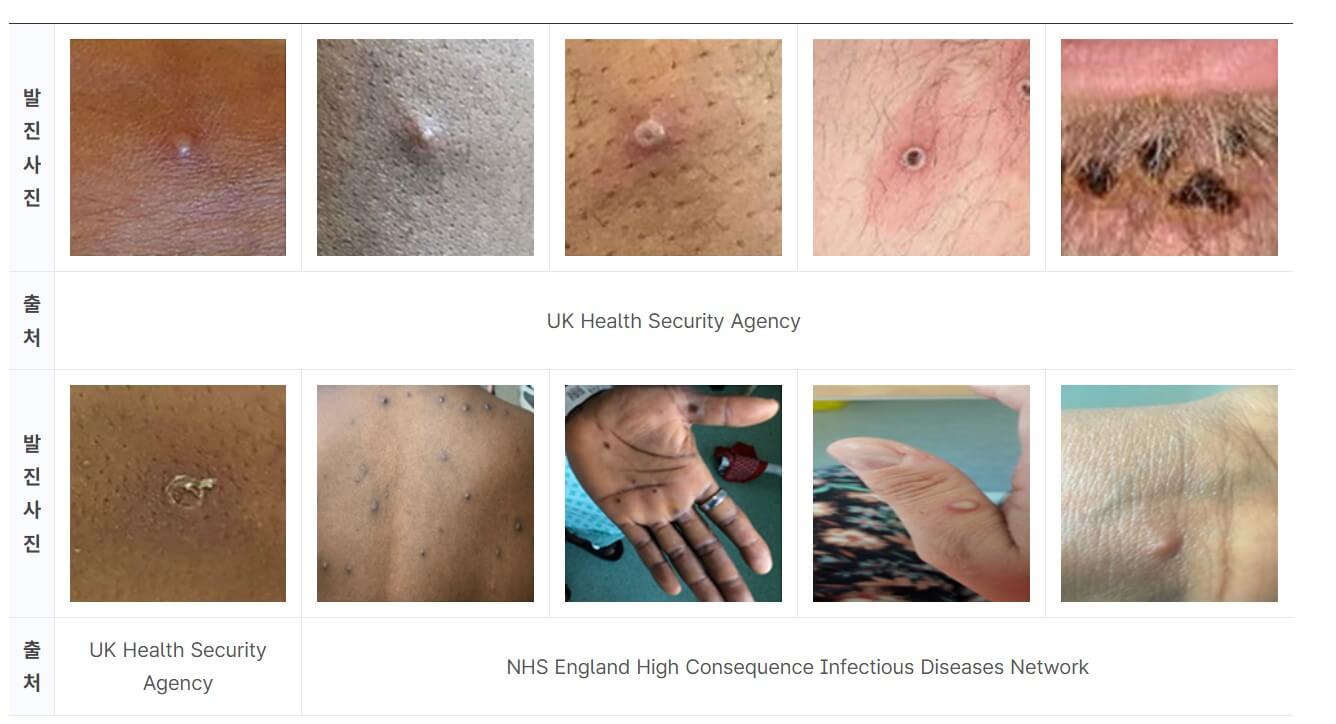 원숭이두창(엠폭스) 초기 증상 원인 감염경로 예방법