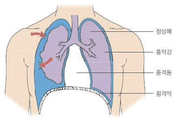 기흉 증상과 원인, 치료 방법까지