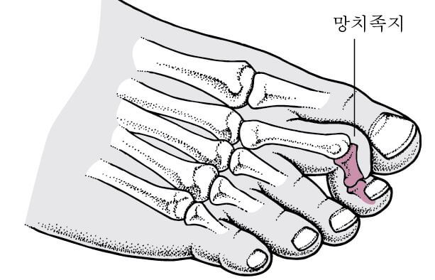 망치발가락-모습