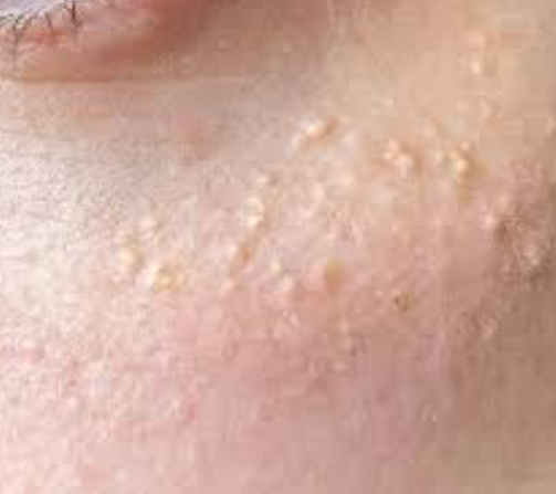 비립종 없애는 방법