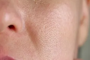 블랙-헤드-제거-방법