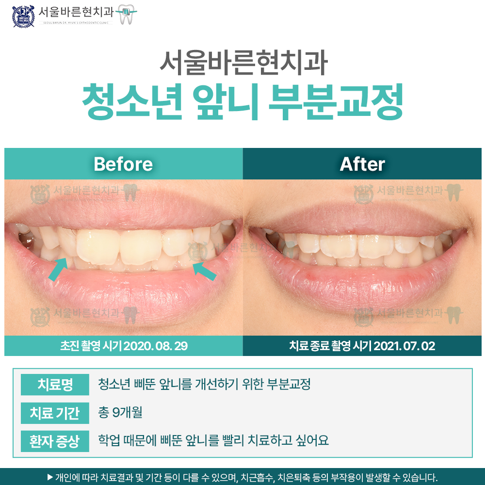 해운대청소년부분교정