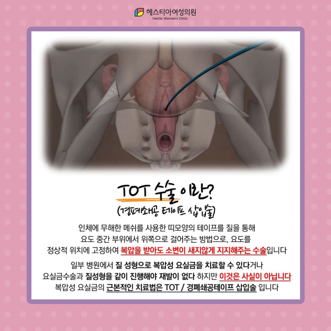요실금수술잘하는곳 이건 꼭 기억하세요! TOT수술