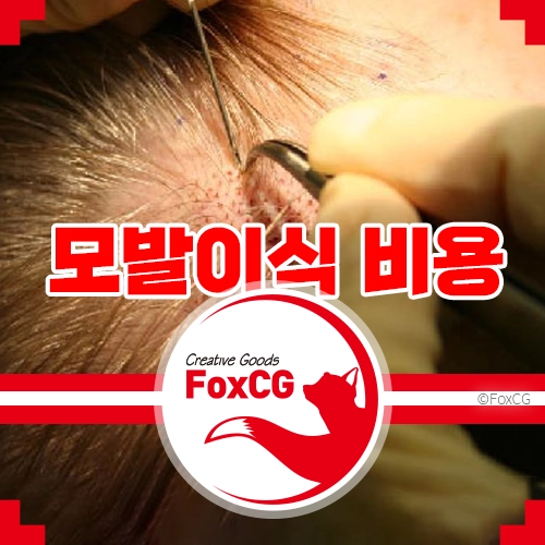 모발이식 비용 2000모 ~ 5000모 가격 비교