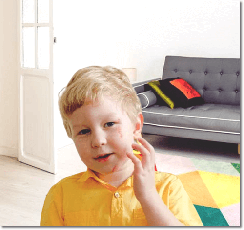 얼굴에 상처난 아이