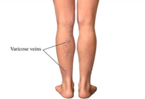 하지정맥류-수술비용