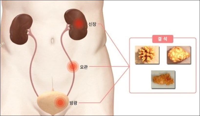 요로결석