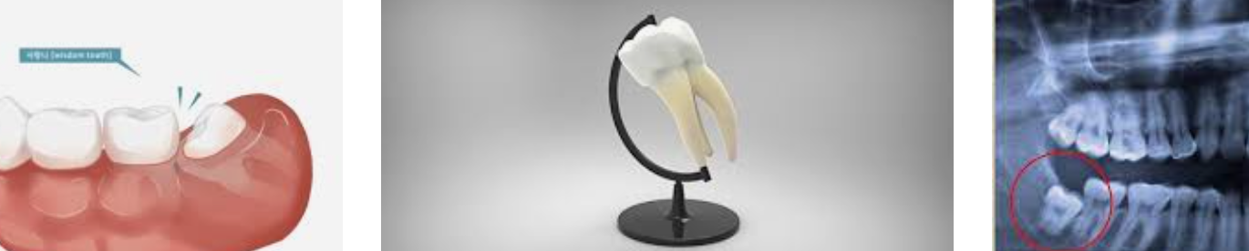 사랑니를 보여주는 일러스트, 및 x-ray사진