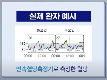 연속혈당측정기