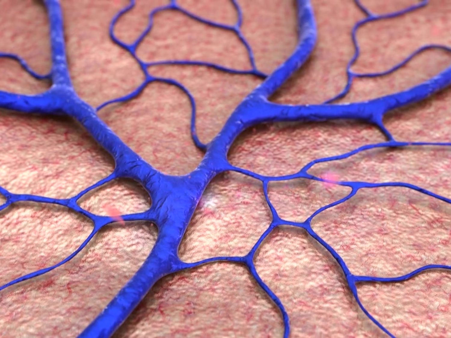 하지정맥류 원인