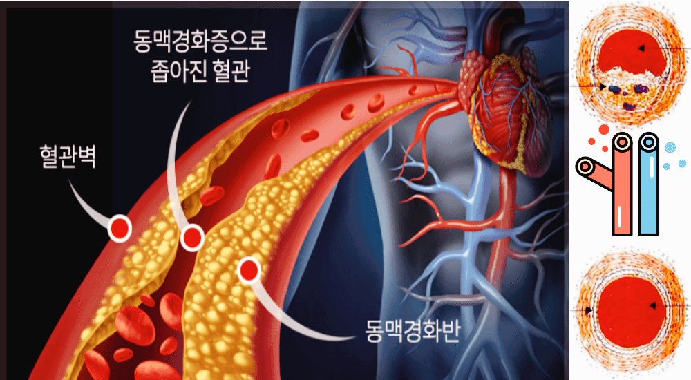 동맥경화증
