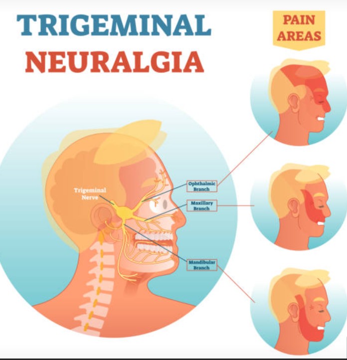 삼차신경통 증상 악화 요인