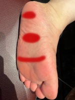 족저근막염-발바닥-통증-부위