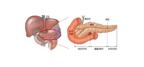 췌장암 초기증상