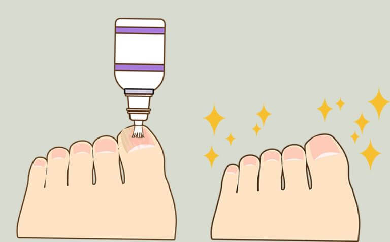 발톱 무좀 부위에 외용제를 바르는 모습