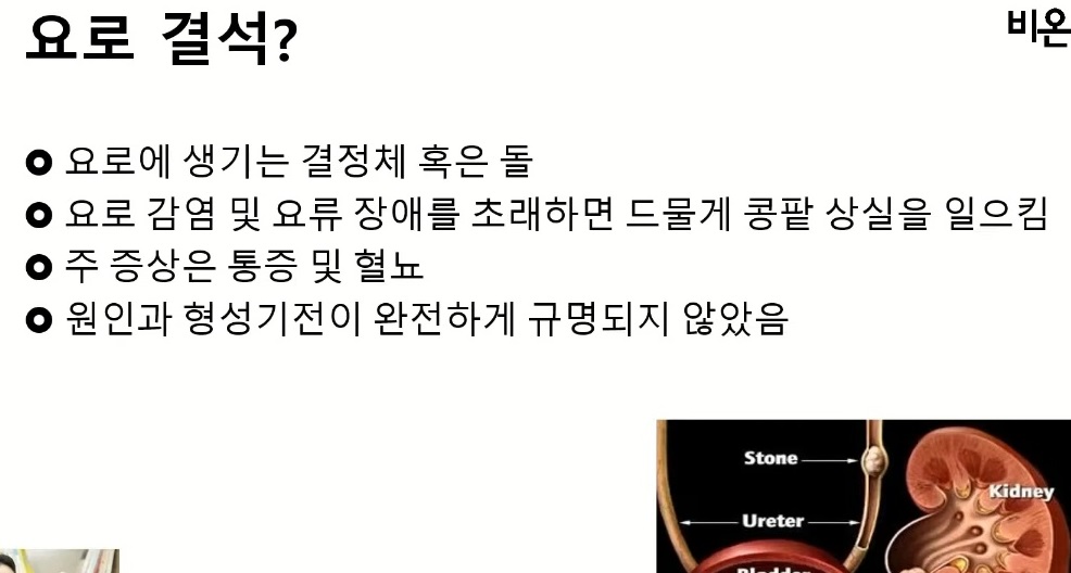 요로결석뜻