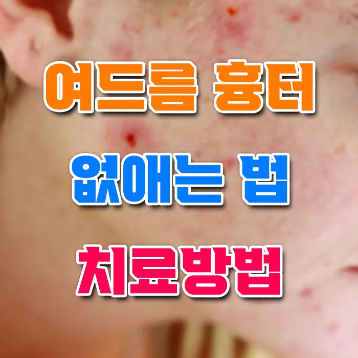 여드름 흉터 없애는 법 치료방법