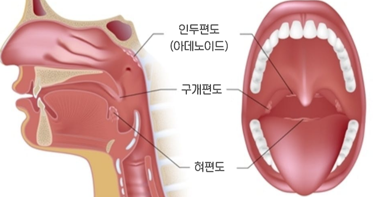 편도의 종류