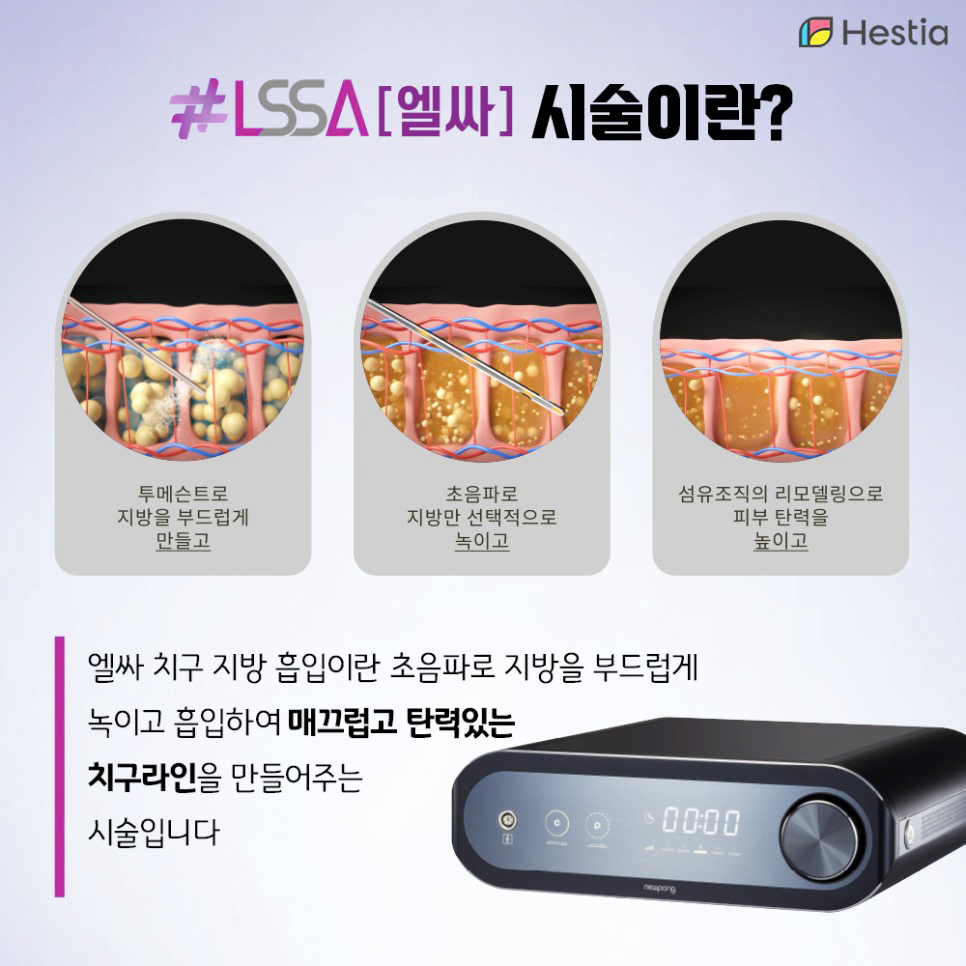 엘싸시술이란?