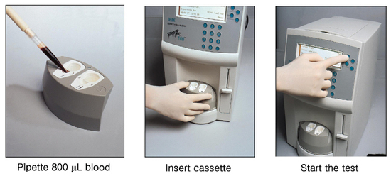 혈소판 기능 검사(PFA-100)의 원리와 임상 적용