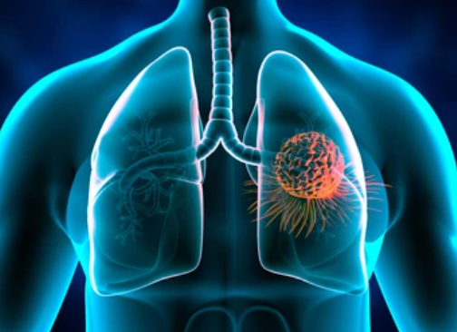 폐암 원인/ 초기증상/ 치료법/ 예방법