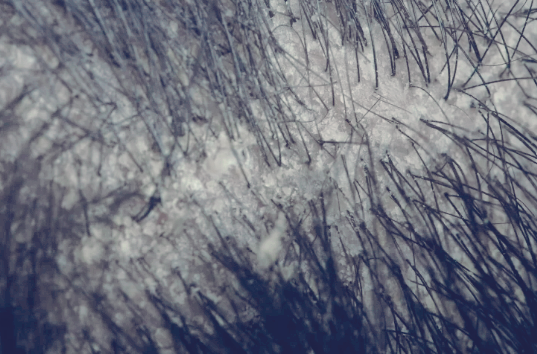 지루성 두피염 완벽 가이드: 증상, 원인, 치료, 관리, 샴푸, 후기까지!