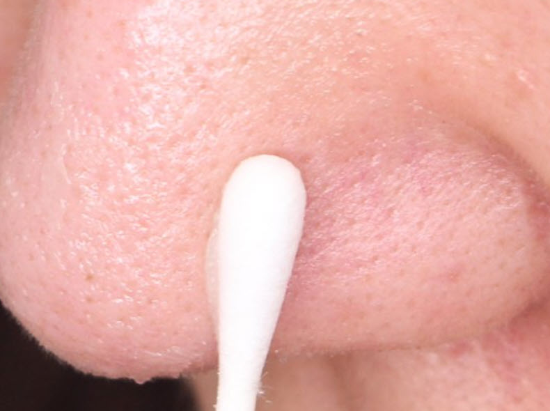 바세린 블랙헤드