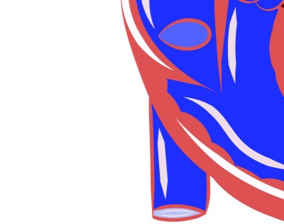 관상동맥 석회화 증상