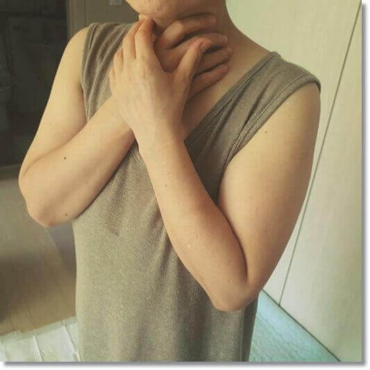 식도 역류질환 환자