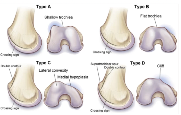 evaluationofthrochleaegroove-typeoftrochleargroove