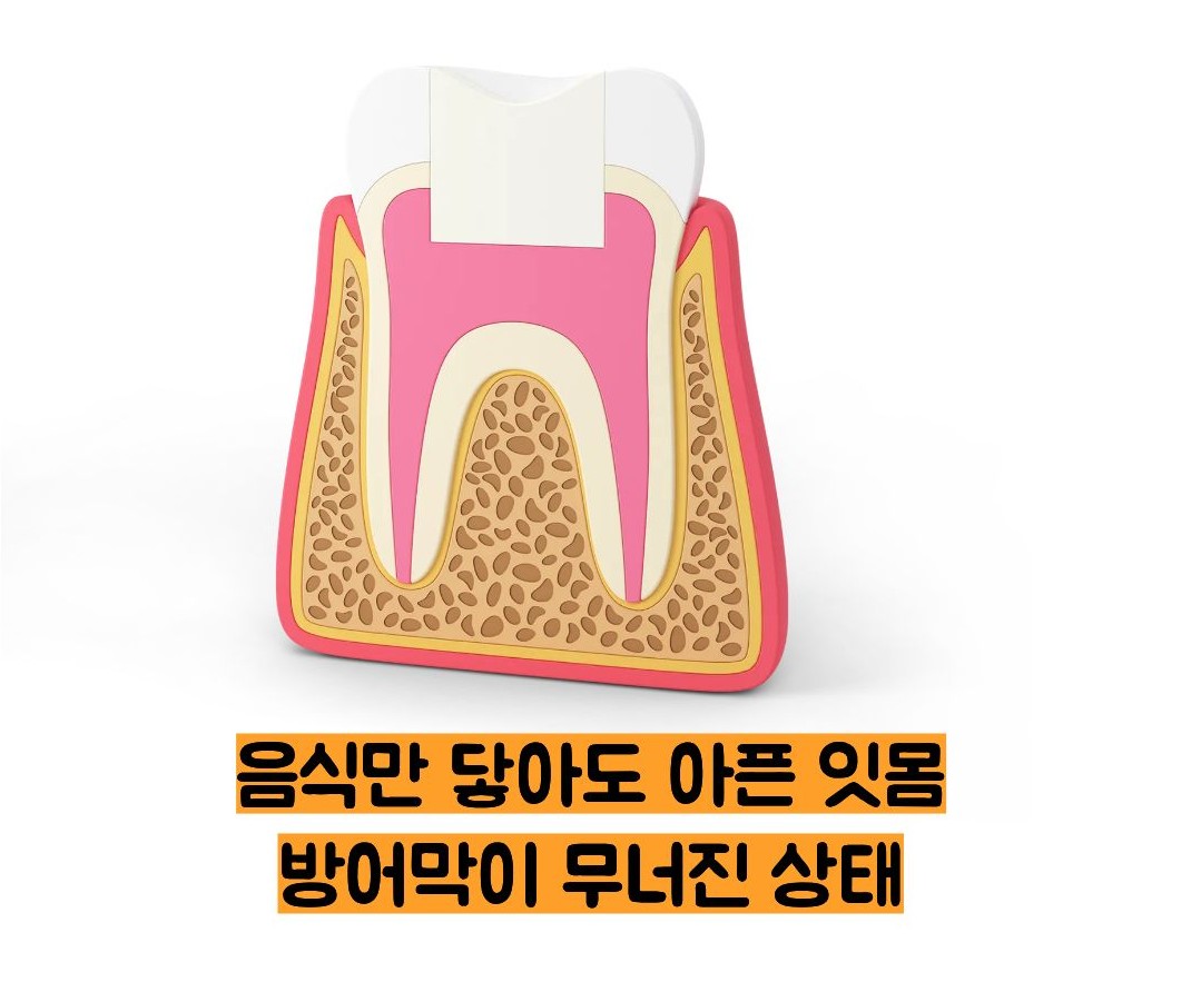 잇몸이 붓고 아플때