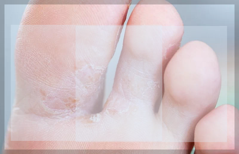 발가락 무좀