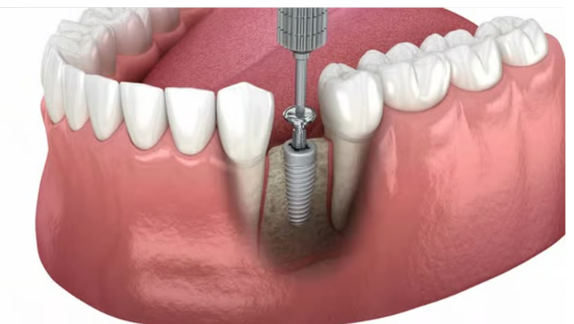 임플란트 뼈이식 과정