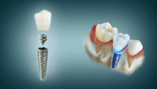 잇몸 고름 임플란트 후 나타날 수 있는 증상들