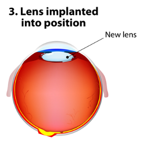 투데이라섹 수술 후기