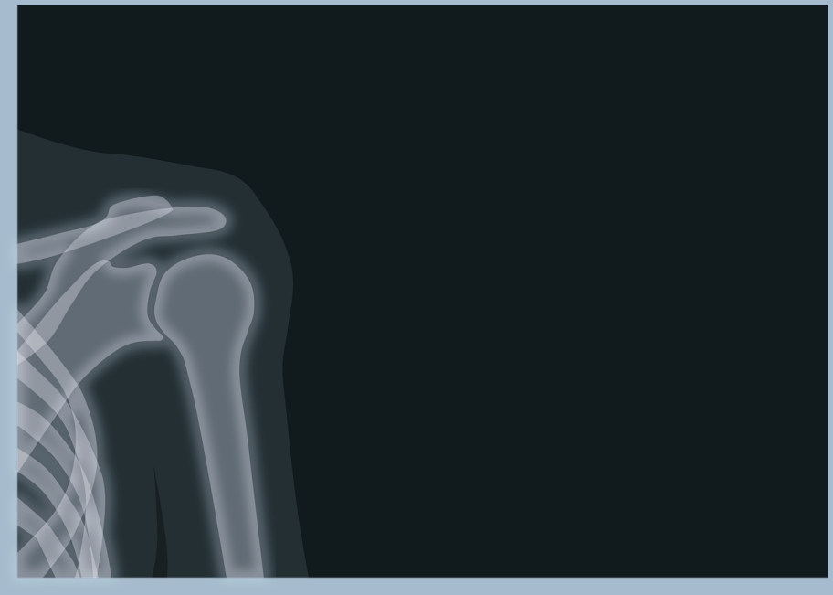 회전근개파열이란? 팔을 들어올리기 힘들다면!