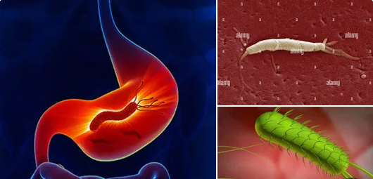 헬리코박터 균 이미지