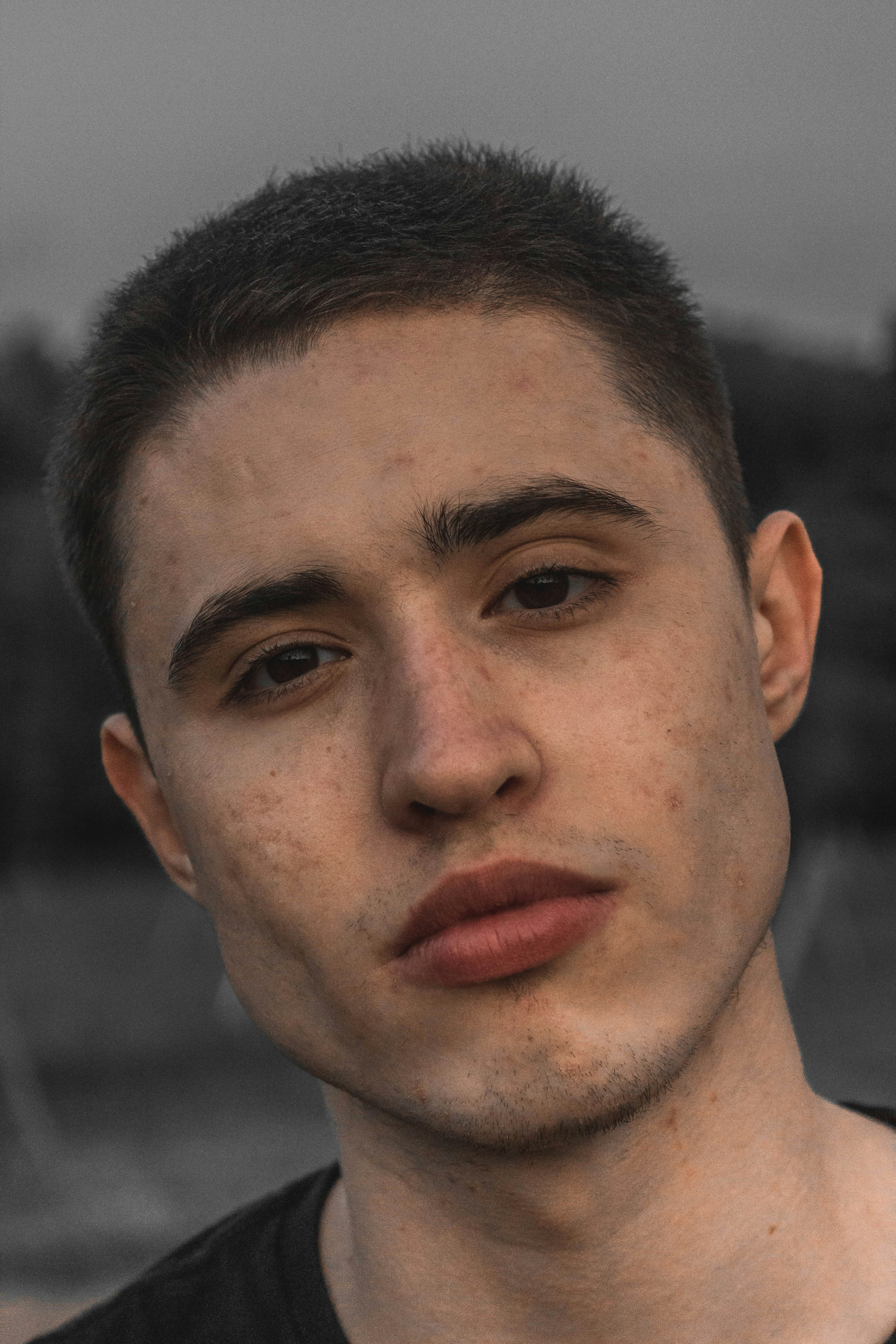 여드름 흉터 없애는법