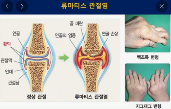 류마티스 관절염의 초기 증상 관련 이미지